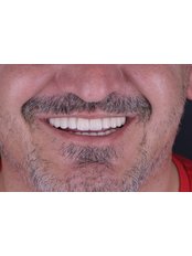 All-on-4 , Double Jaw, Neodent by Straumanngroup - UltimaDent