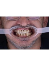 All-on-4 , Double Jaw, Neodent by Straumanngroup - UltimaDent