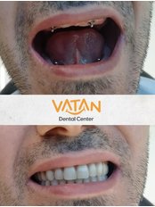 Dental Implants - Vatan Dental Center