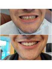Six Month Smiles™ - WestDent Clinic