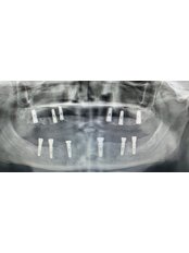 Implant Bridge - WestDent Clinic