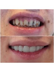Dental Crowns - WestDent Clinic