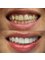 WestDent Clinic - hollywood smile - veneers 