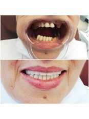 Dental Crowns - WestDent Clinic