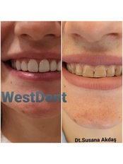 Hollywood Smile - WestDent Clinic