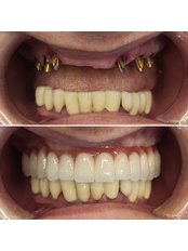 All-on-6 Dental Implants - WestDent Clinic