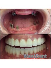 Implant Bridge - WestDent Clinic
