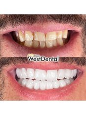 Dental Bridges - WestDent Clinic