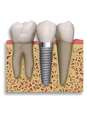 Dental Implants - Dentalpark Kayseri Denthospital
