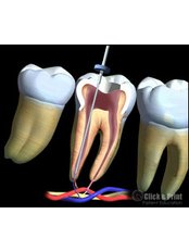Root canals - Dentalpark Kayseri Denthospital