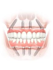 All-on-4 Dental Implants - Dent Halikarnas Policlinic of Oral & Dental Health