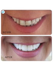 Zirconia Crown - Dent Halikarnas Policlinic of Oral & Dental Health