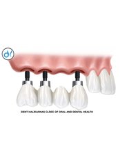 Dental Implants - Dent Halikarnas Policlinic of Oral & Dental Health