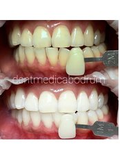 Laser Teeth Whitening - Dent Medica Bodrum - Implant Specialist Dr. Kübra Çakır
