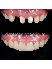 Zirconia Crown - Dent Medica Bodrum - Implant Specialist Dr. Kübra Çakır