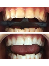 Teeth Whitening - Denthipokrat Bodrum