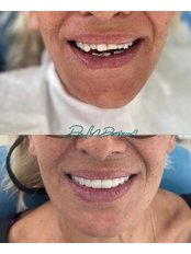 Zirconia Crown - Dentist Can Demircan
