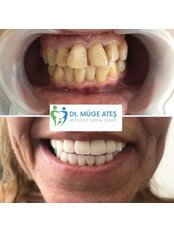 Porcelain Crown - Dt. Muge Ates Aesthetic Dental Clinic
