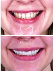 Smile Makeover E-max (20 crowns) - Focus Dental Clinic