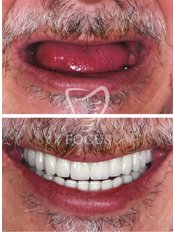 All-on-4 Zahnimplantate - Focus Dental