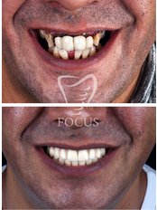 All-on-6 Zahnimplantate - Focus Dental