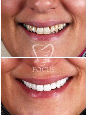 Smile Makeover Zirconium (20 crowns) - Focus Dental Clinic