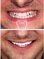 Lächeln Rundumbehandlung - Focus Dental