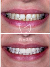 Lächeln Rundumbehandlung - Focus Dental