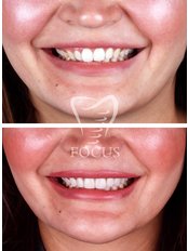 Smile Makeover Laminate (20 e-max veneers) - Focus Dental Clinic