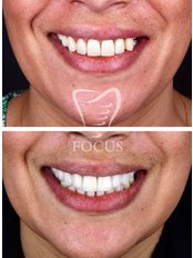 Smile Makeover Zirconium (20 crowns) - Focus Dental Clinic