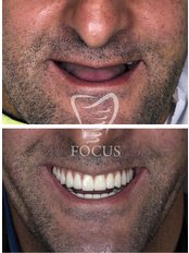 All-on-6 Dental Implants per Jaw - Focus Dental Clinic