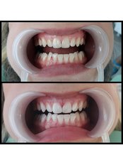 Teeth Whitening - MyndosDent Oral and Dental Clinic