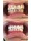 MyndosDent Oral and Dental Clinic - Bleaching 