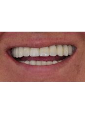 Porcelain Crown - MyndosDent Oral and Dental Clinic