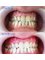 MyndosDent Oral and Dental Clinic - Teeth Whitening 