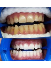 Teeth Whitening - Nefes Dent