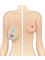 YNG Bodrum Medlife Klinik - Breast lift 