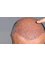 YNG Bodrum Medlife Klinik - Hair implant 