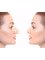 YNG Bodrum Medlife Klinik - Nose correction 