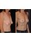 YNG Bodrum Medlife Klinik - Breast augmentation 
