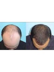 Hair Loss Specialist Consultation - YNG Bodrum Medlife Klinik