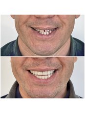 Smile Makeover - HSmile Dental Clinic