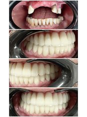 Dental Implants - HSmile Dental Clinic