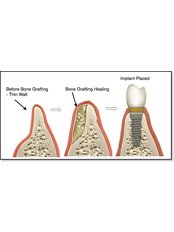Bone Graft - HSmile Dental Clinic