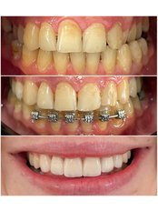 Dental Crowns and Veneers - HSmile Dental Clinic