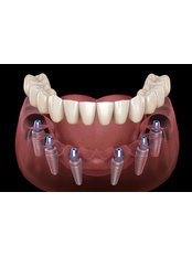All-on-6 Dental Implants - HSmile Dental Clinic