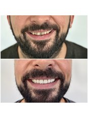 Hollywood Smile - HSmile Dental Clinic