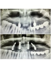 All-on-4 Dental Implants - HSmile Dental Clinic