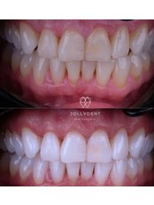 Teeth Whitening - JollyDent Fethiye