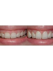 Gum Contouring and Reshaping - JollyDent Fethiye